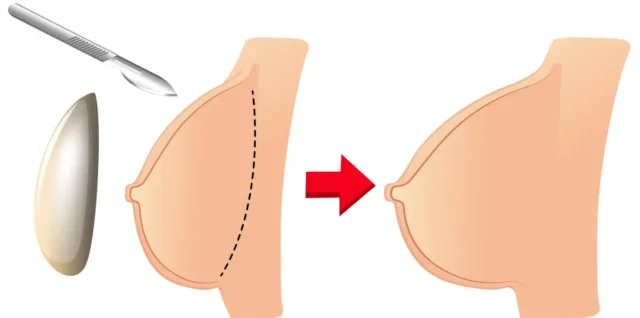 lipofilling mammaire
