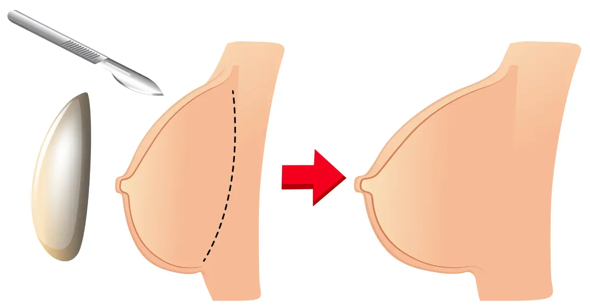 lipofilling mammaire